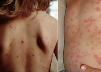 НАОЗ предупреждает население о рисках распространения кори и призывает к вакцинации