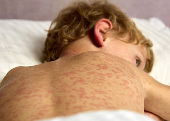 Растет число заболевших корью: в Гагаузии выявили контактного ребенка